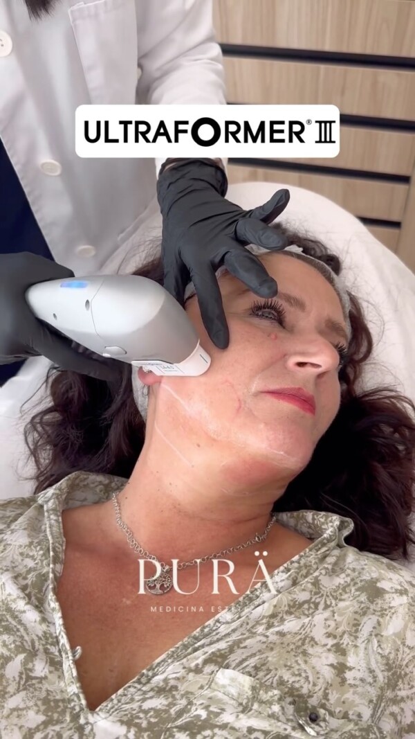 ✨ Descubre el poder del lifting sin cirugía con Ultraformer III ✨En PURÄ, estamos revolucionando el rejuvenecimiento facial y de papada con Haifu Ultraformer 3, el tratamiento de ultrasonido focalizado que redefine y tensa la piel sin necesidad de bisturí. Hoy, nuestra bella paciente experimenta este innovador procedimiento para lograr una piel más firme y un contorno redefinido, con resultados naturales y duraderos.

¿Quieres saber cómo este tratamiento puede transformarte? 

Escríbenos y descubre el camino hacia una versión más joven y radiante de ti misma. ¡Tu piel merece lo mejor! 🌿

hifumalaga ultraformer ultraformer3